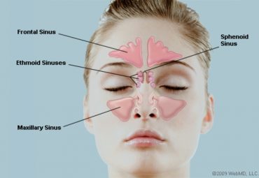 Ayurvedic Herbal Remedies and Preventive Tips For Sinus